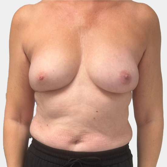 Fat Transfer or Lipomodelling - After Procedure Comparison