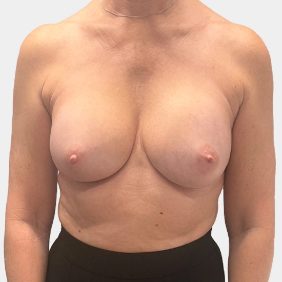 Fat Transfer or Lipomodelling - Before Procedure Comparison