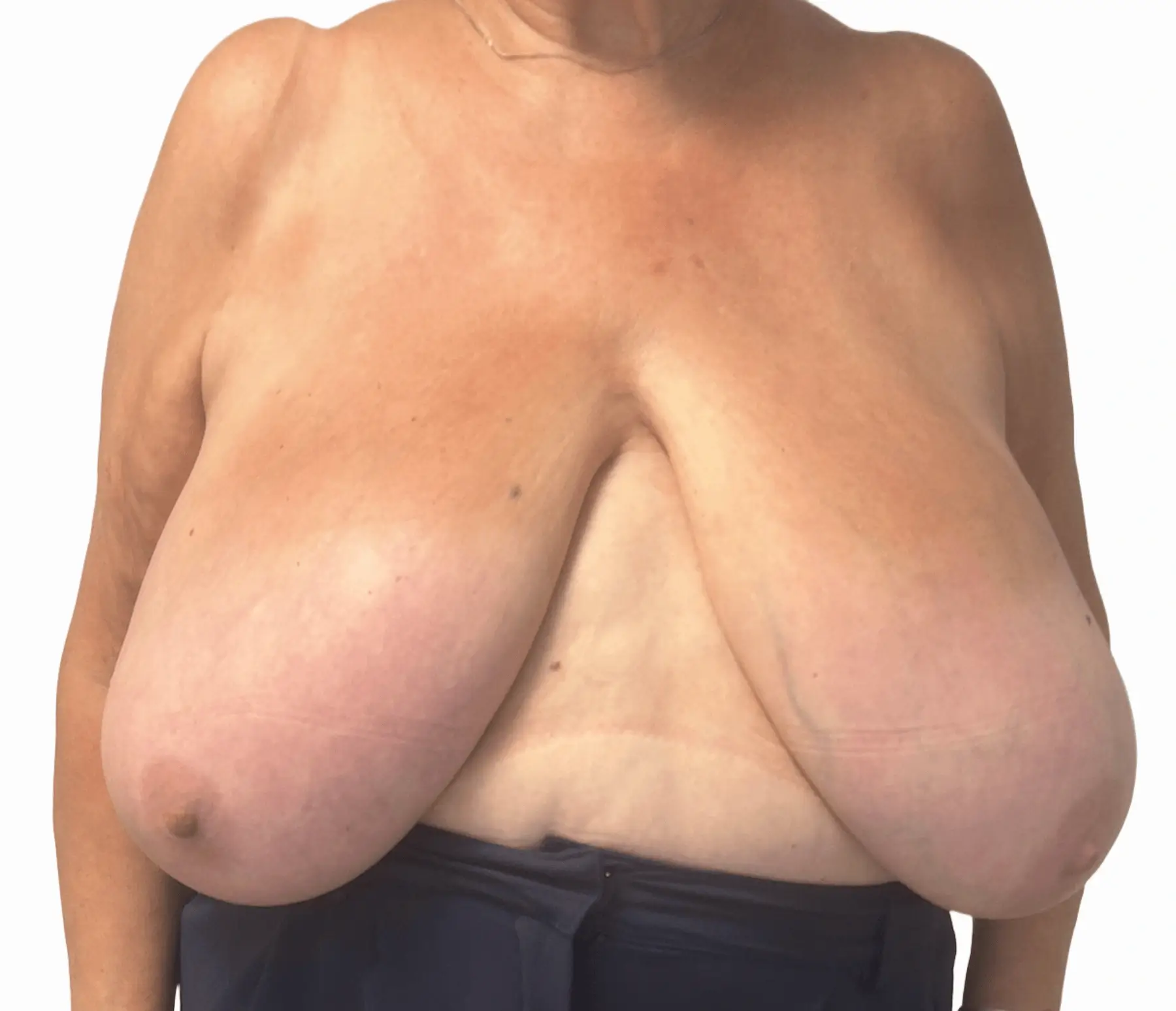 Breast Reduction Surgery - Before Procedure Comparison
