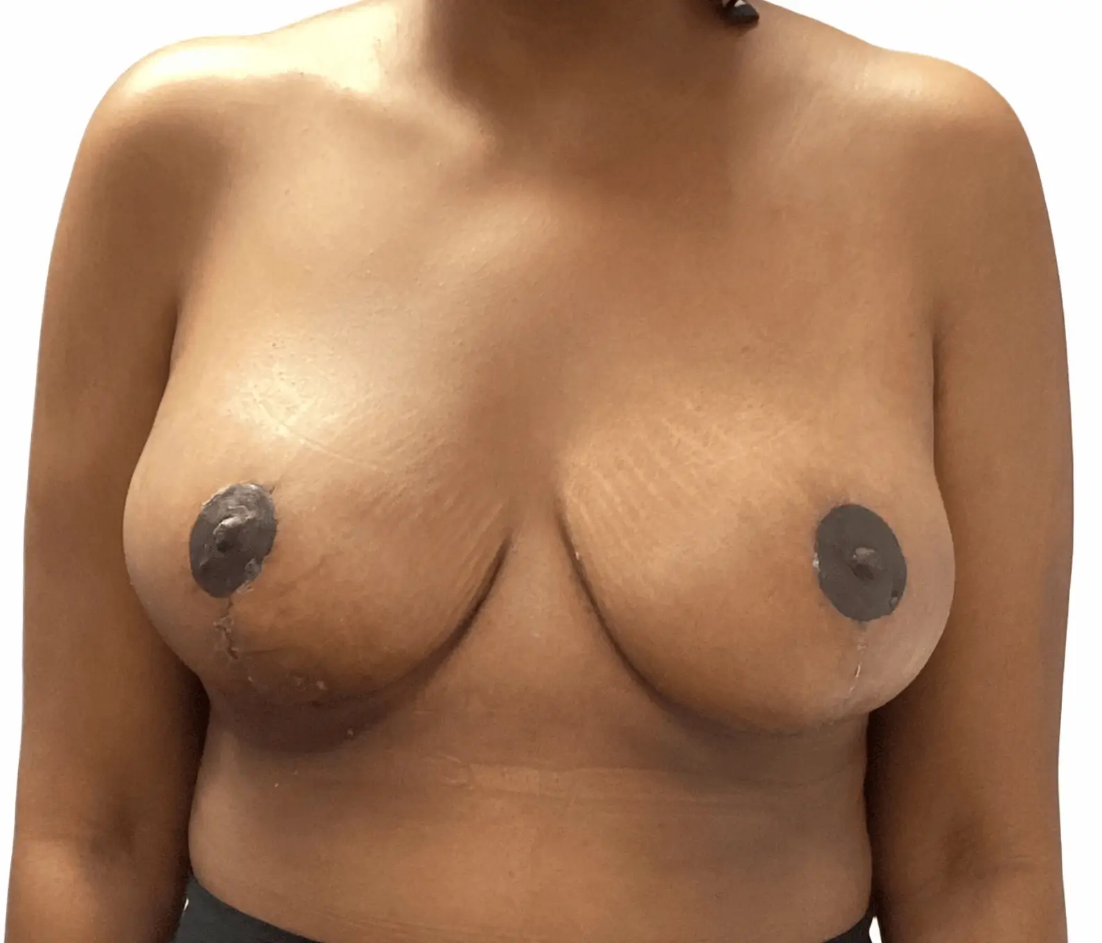 Breast Reduction Surgery - After Procedure Comparison