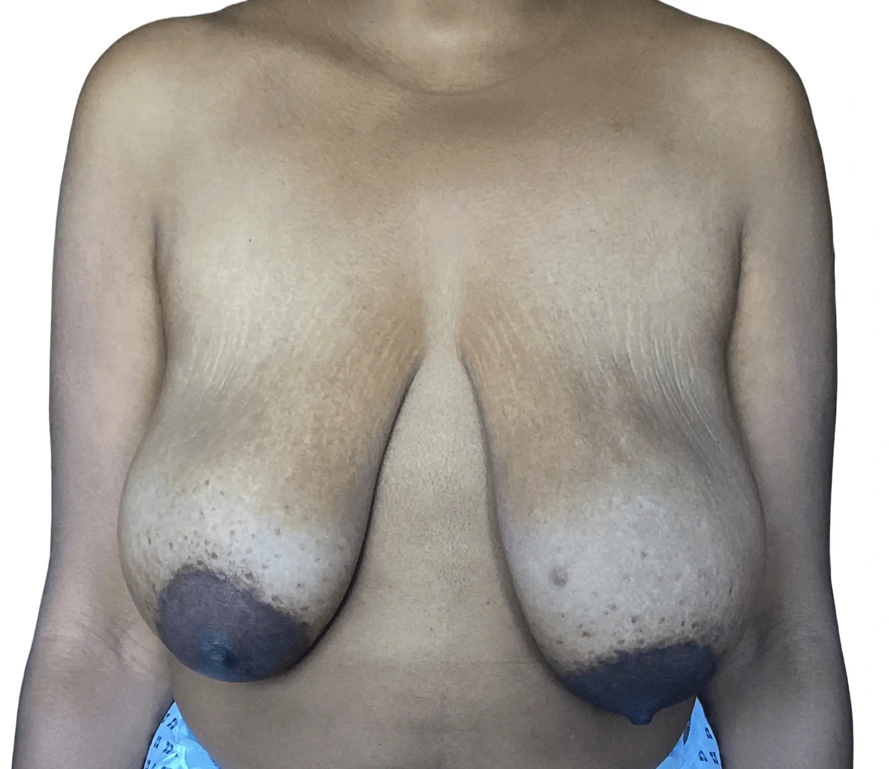 Breast Reduction Surgery - Before Procedure Comparison